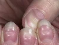 How to restore nails after shellac: effective methods