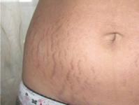 How to remove stretch marks and is it possible to completely get rid of stretch marks? How to remove stretch marks on the body at home