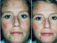 Ozone therapy procedure: reviews, before and after photos Ozone therapy for acne: benefits and harms