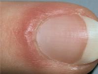 Effective methods for treating an abscess on the toe at home