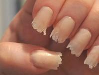 Distrofia unghiilor: cauzele distrofiei unghiilor pe maini si picioare si tratament cu remedii populare