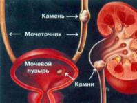 Какво е хидронефроза по време на бременност Хидронефроза на бъбреците симптоми лечение по време на бременност