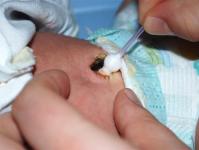 Regeln für die Behandlung der Nabelwunde eines Neugeborenen mit Brillantgrün